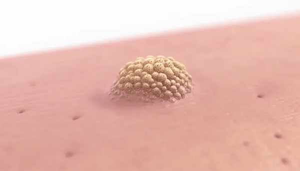 Crema Veneno de Abejas Para Verrugas