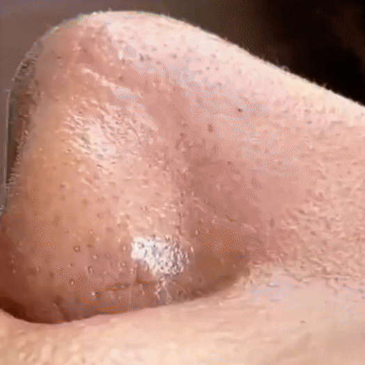 Aspiradora de Puntos Negros Mágica