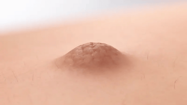 Crema Veneno de Abejas Para Verrugas