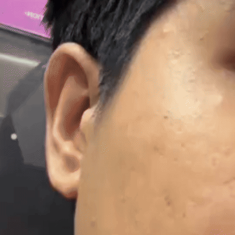 Gel Milagroso para el Acné